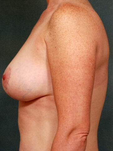 Case # 5 after photo