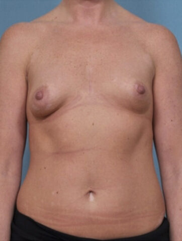 Case # 25 before photo