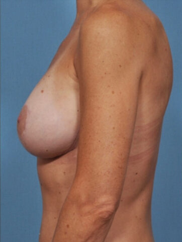 Case # 23 after photo