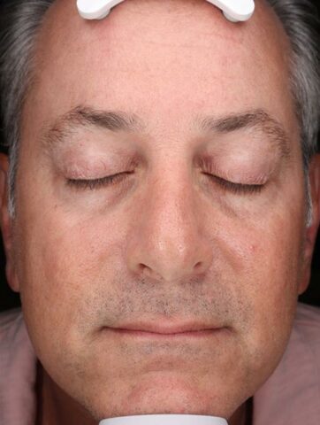 Case # 50 after photo