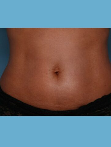 Case # 51 before photo