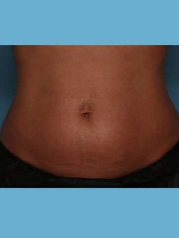 Case # 51 after photo