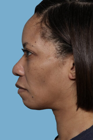 Case # 46 before photo