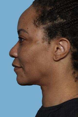 Case # 46 after photo