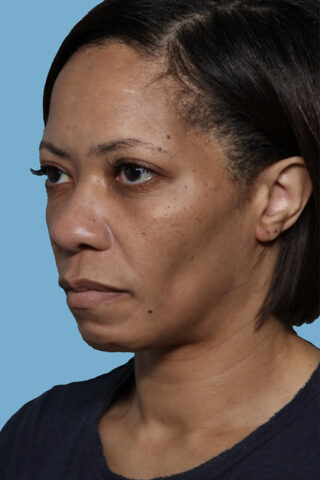 Case # 46 before photo