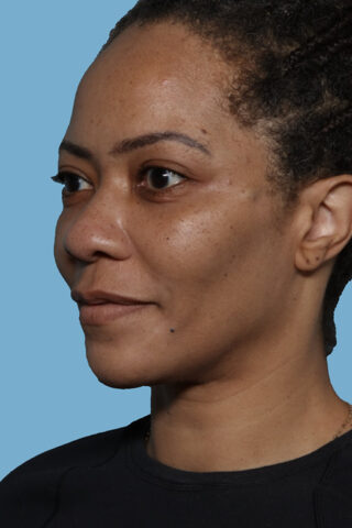 Case # 46 after photo