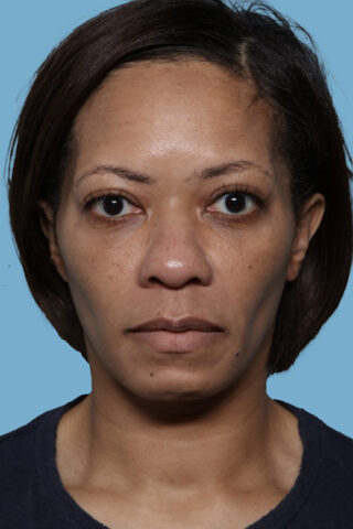 Case # 46 before photo