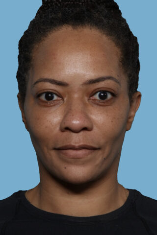 Case # 46 after photo