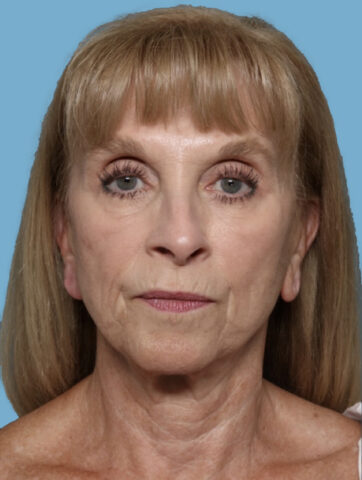 Case # 1 before photo