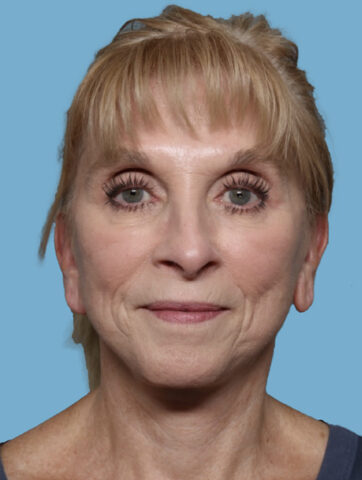 Case # 1 after photo