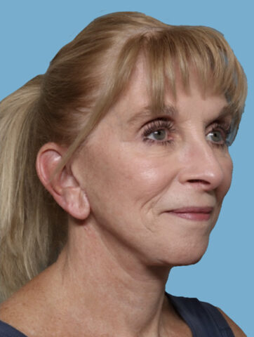 Case # 1 after photo