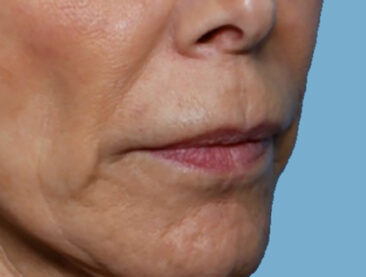 Case # 1 before photo