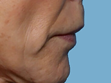 Case # 1 before photo