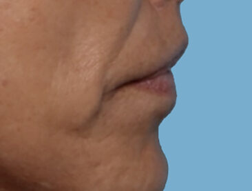 Case # 1 after photo