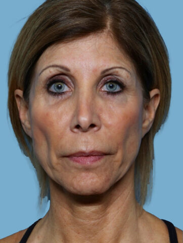 Case # 5 before photo