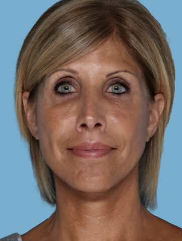 Case # 5 after photo