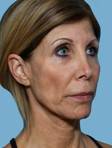 Case # 5 before photo