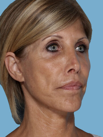 Case # 5 after photo