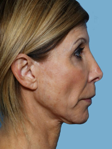 Case # 5 before photo