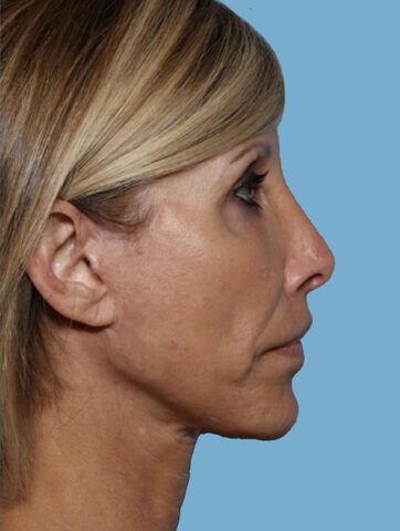 Case # 5 after photo