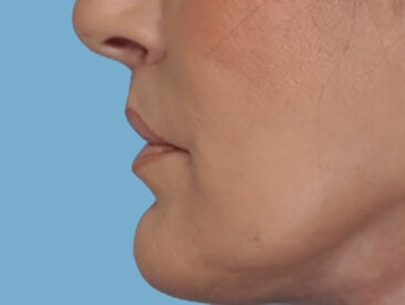 Case # 2 after photo