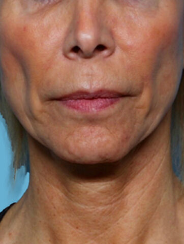 Case # 3 before photo