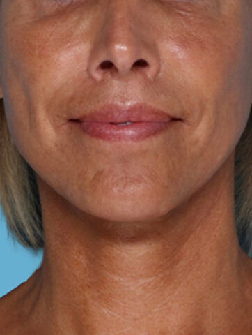 Case # 3 after photo