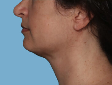 Case # 2 after photo