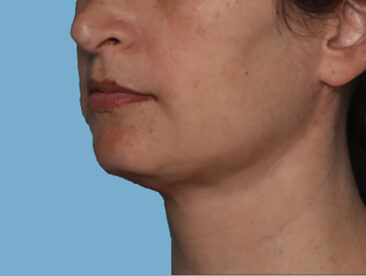 Case # 2 after photo