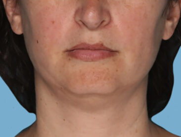 Case # 2 before photo