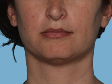 Case # 2 after photo