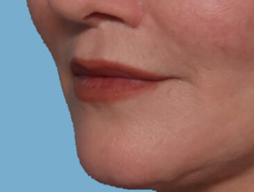 Case # 3 after photo