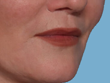 Case # 3 after photo