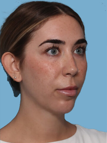 Case # 6 after photo