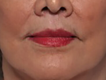 Case # 4 after photo