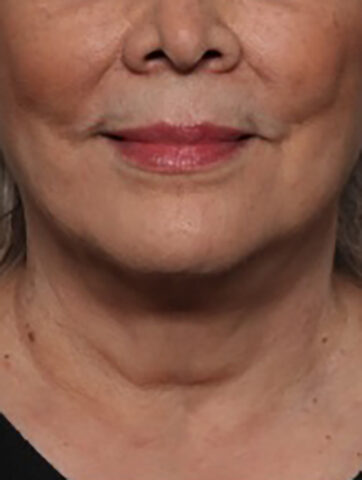 Case # 4 before photo