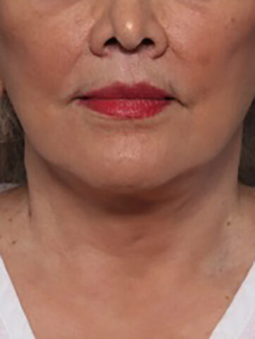 Case # 4 after photo