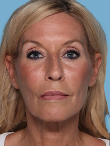 Case # 3 before photo