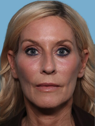 Case # 3 after photo