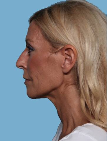 Case # 3 before photo