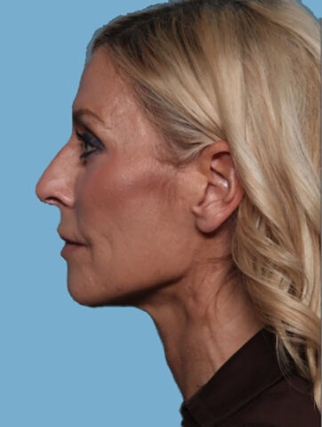 Case # 3 after photo