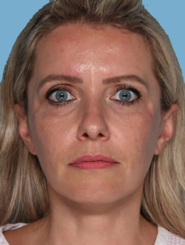 Case # 4 after photo