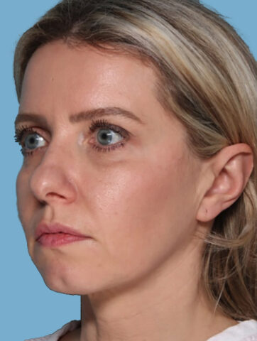 Case # 4 before photo