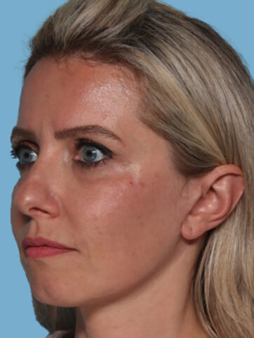 Case # 4 after photo