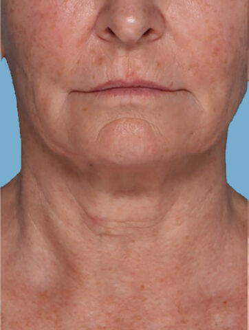 Case # 5 before photo