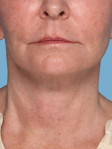 Case # 5 after photo