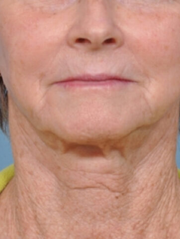 Case # 6 before photo