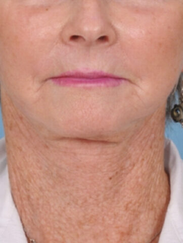 Case # 6 after photo