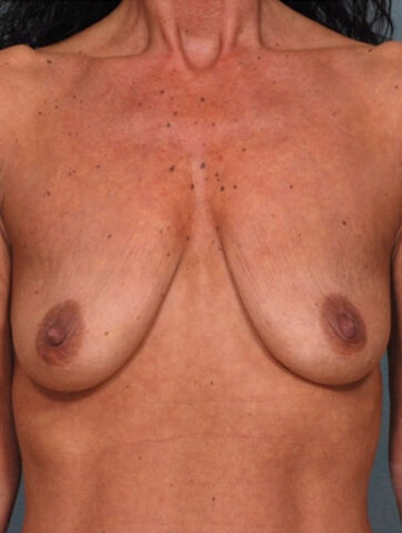 Case # 11 before photo