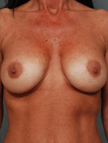 Case # 11 after photo